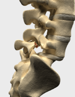 Lumbar Spondylolisthesis, Las Vegas