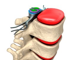 Surgical Disc Replacement