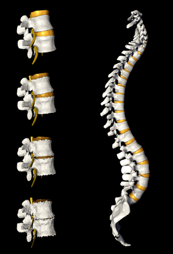 Stage of Degenerative Spinal Discs, Las Vegas