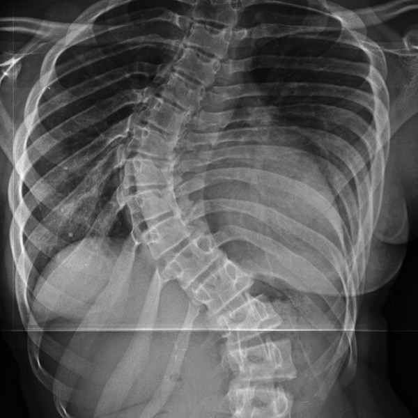 Deformed Spine Treatment in Las Vegas
