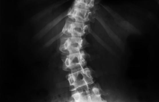 Spinal Scoliosis X-ray, Las Vegas