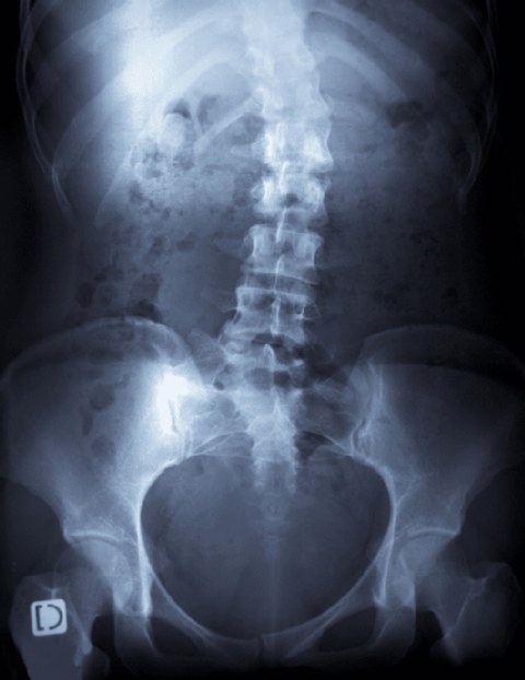 Scoliosos X-ray, Las Vegas