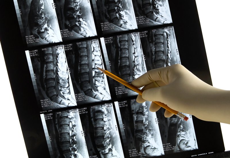 Slipped Discs Treatments in Las Vegas, NV